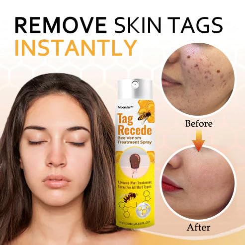 Tag & Wart Remover Spray - Wart and Tags Removal Treatment Spray